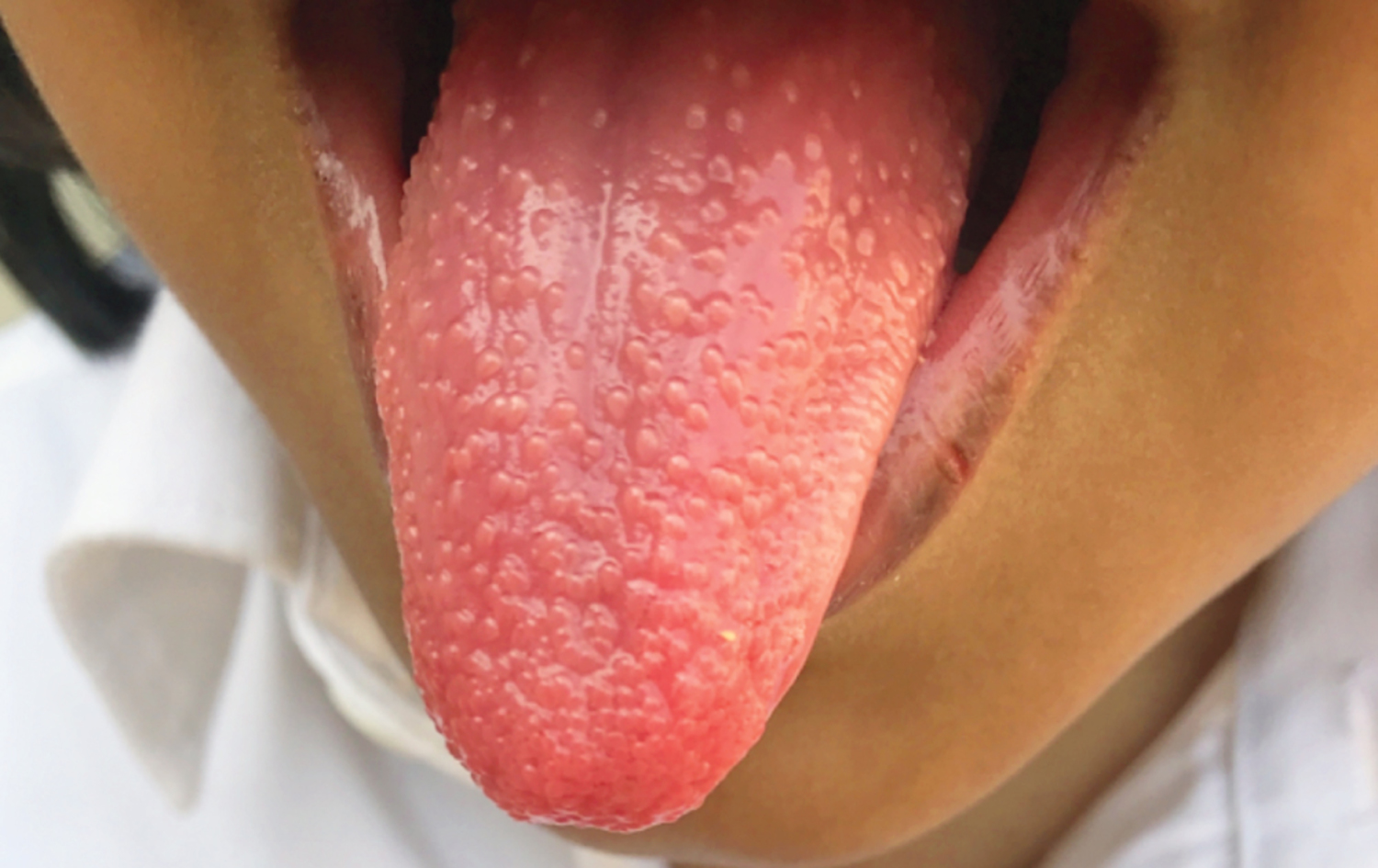 Streptococcal pharyngitis