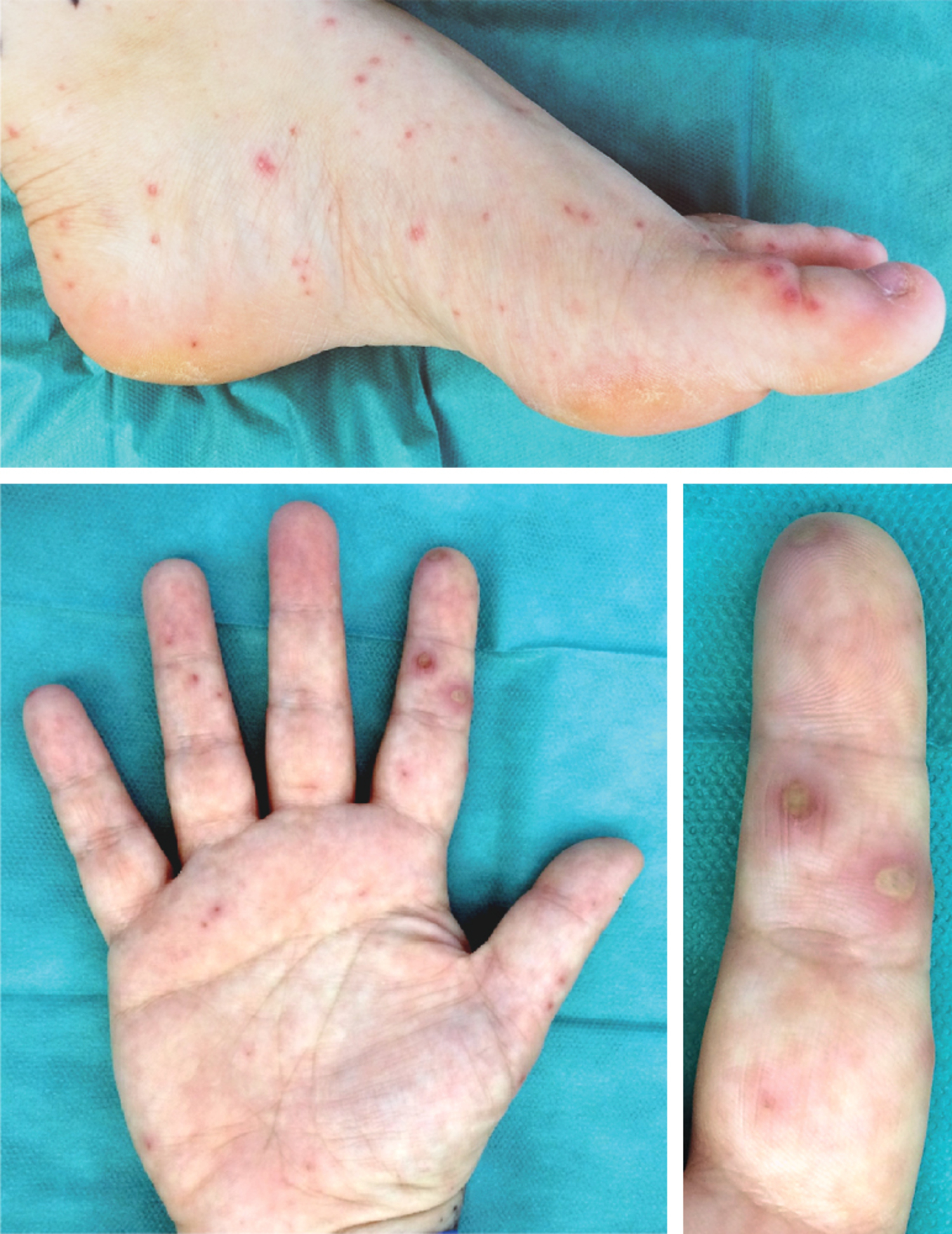 Rat bite fever