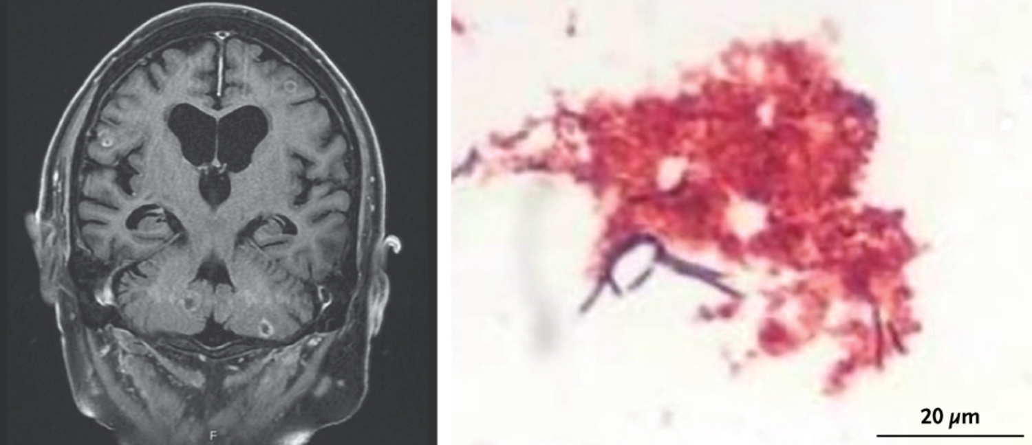Nocardiosis