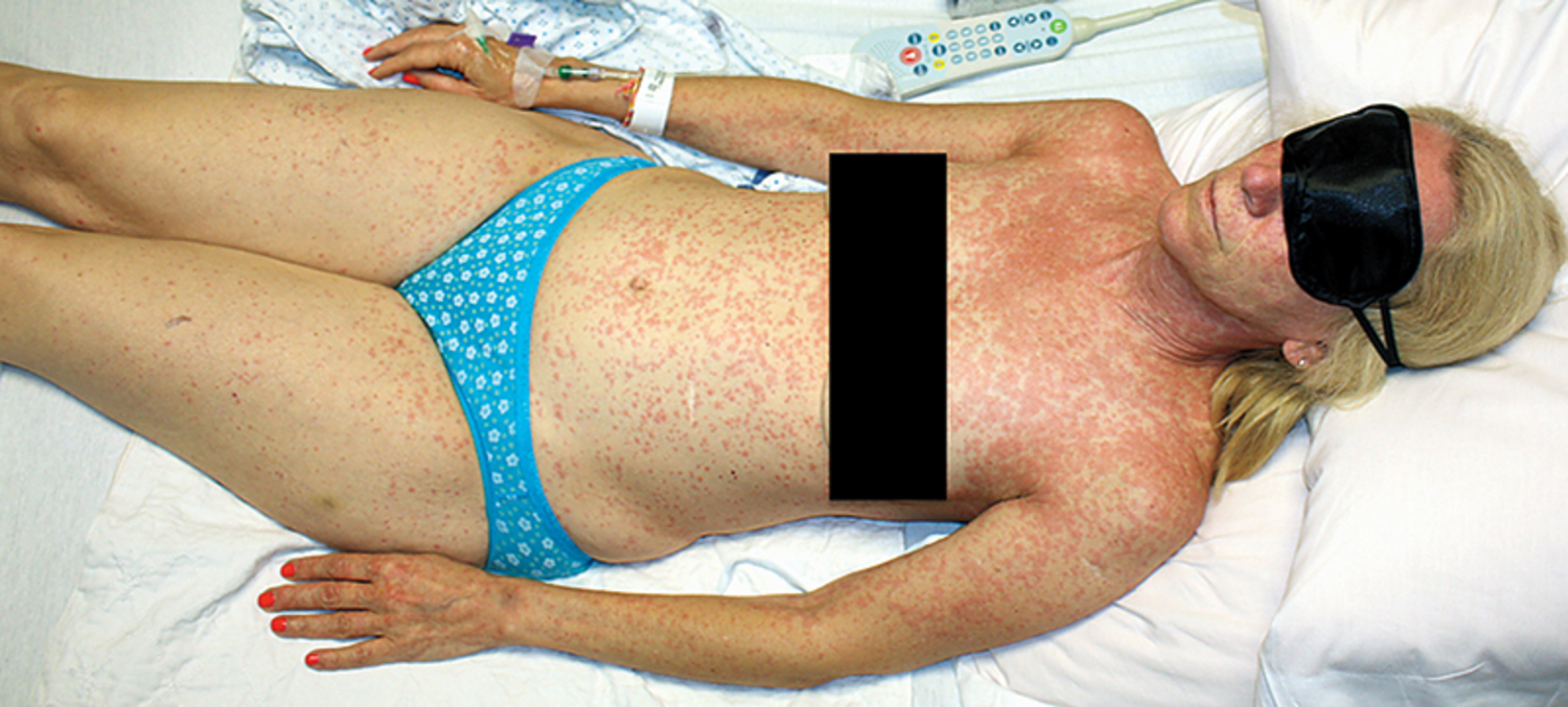 Measles