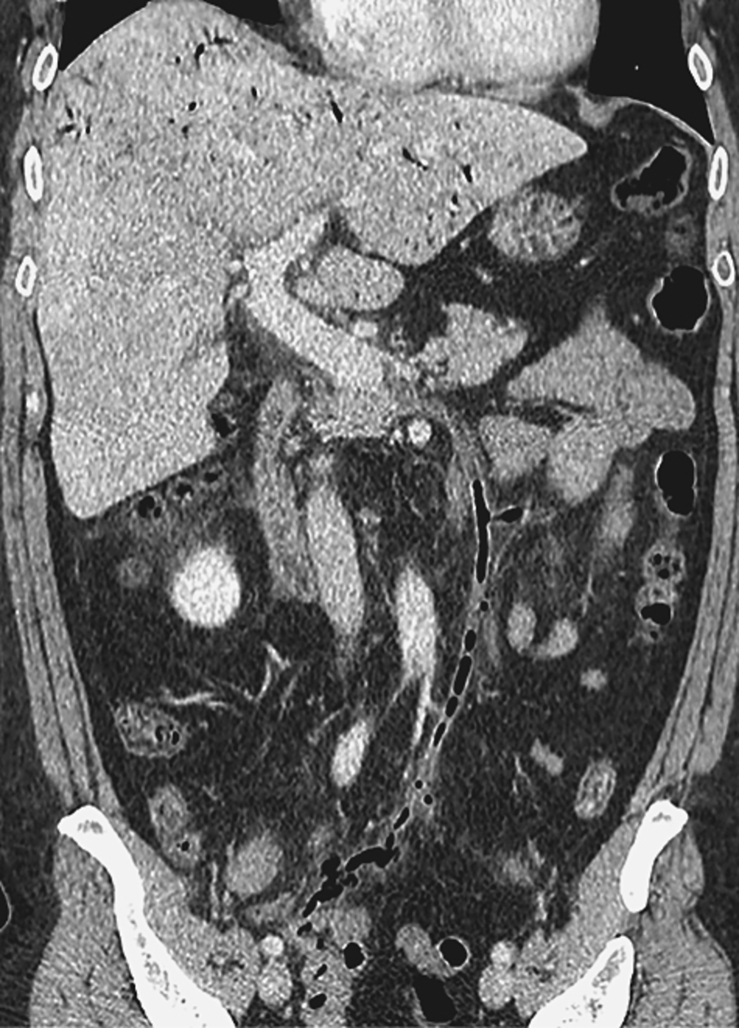 Pylephlebitis