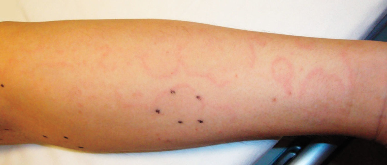 Erythema marginatum
