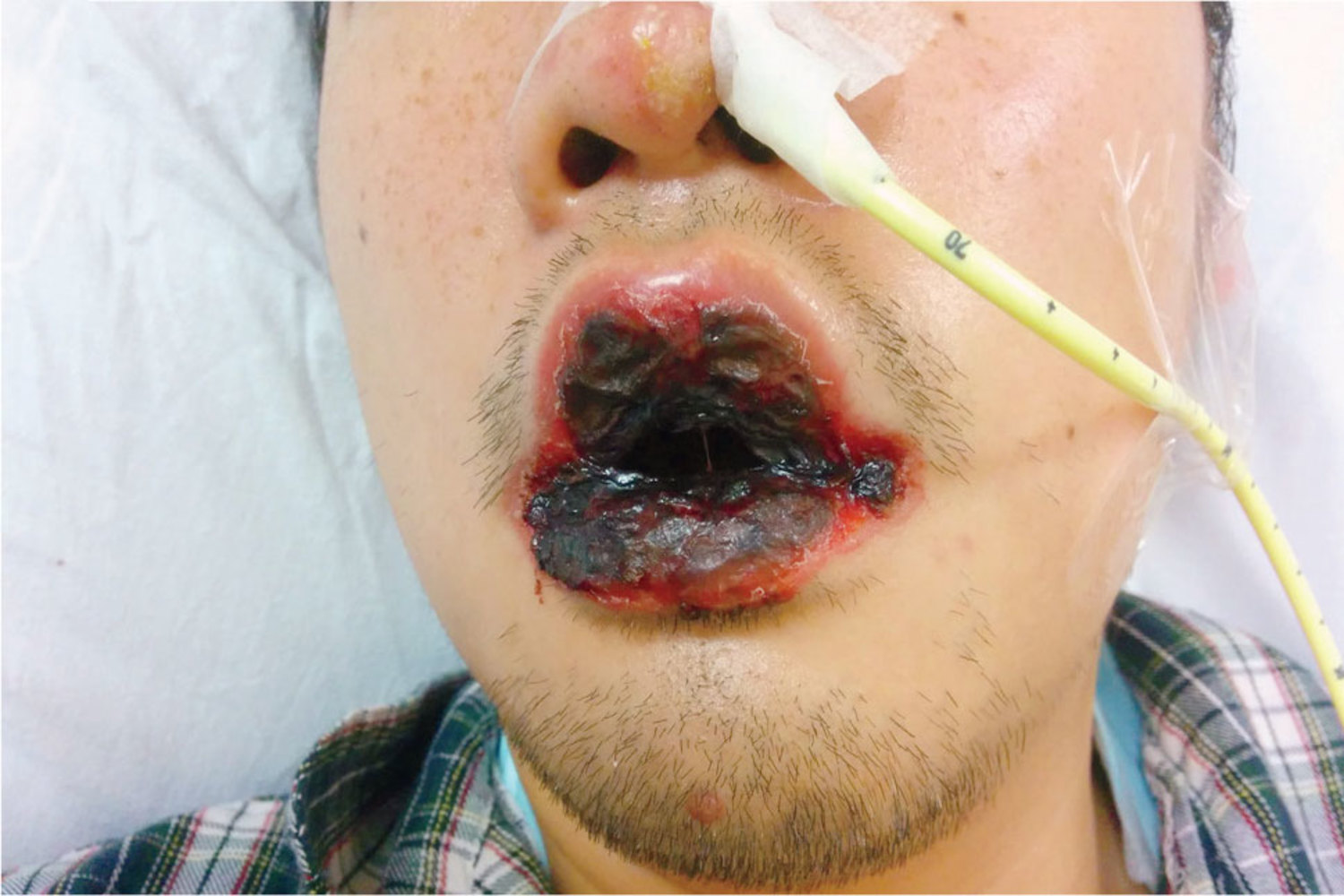 Mycoplasma pneumoniae-associated mucositis