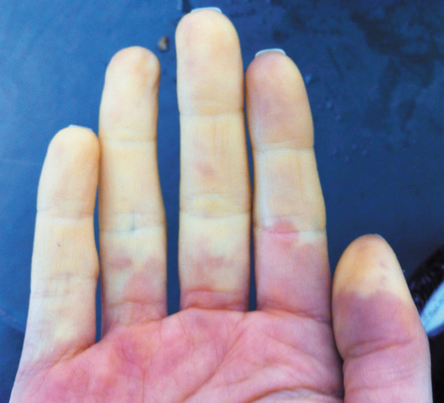 Raynaud's phenomenon