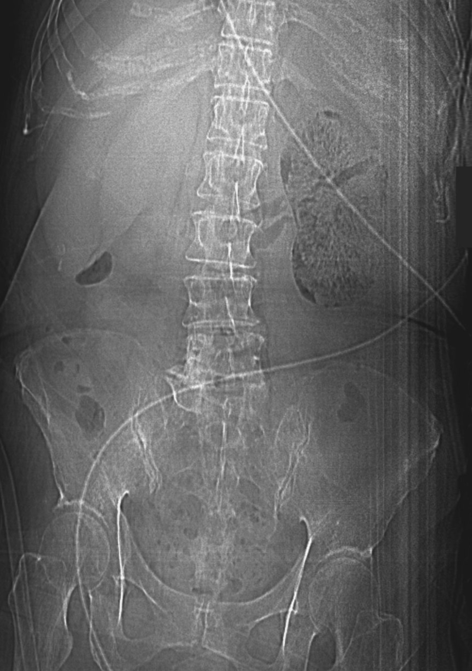 Emphysematous pyelonephritis
