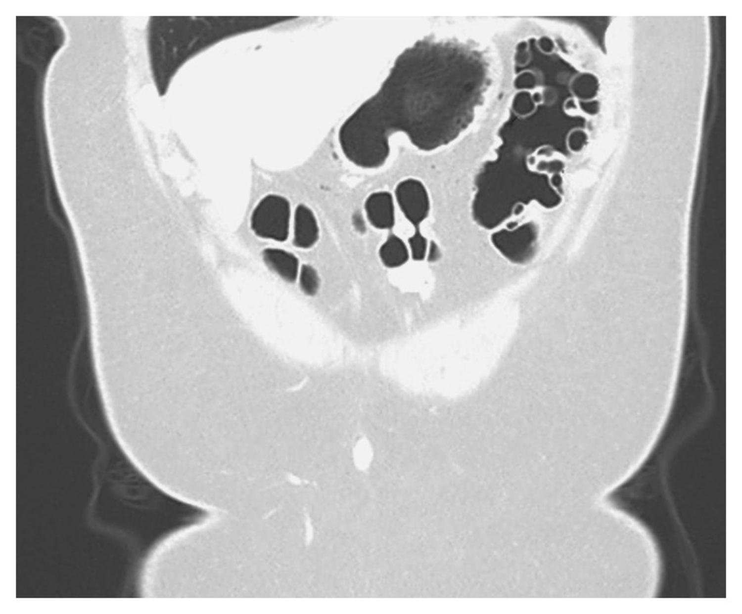 Pneumatosis cystoides coli