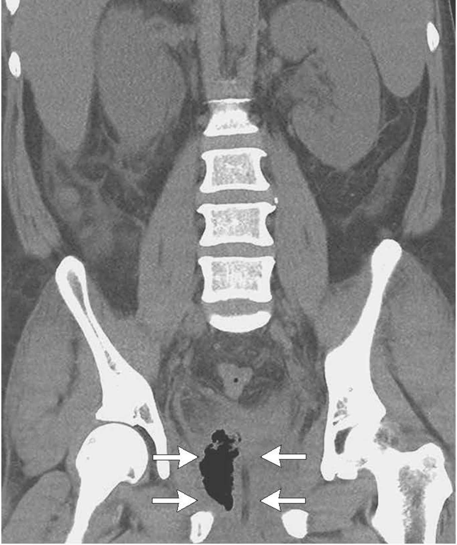 Emphysematous prostatitis