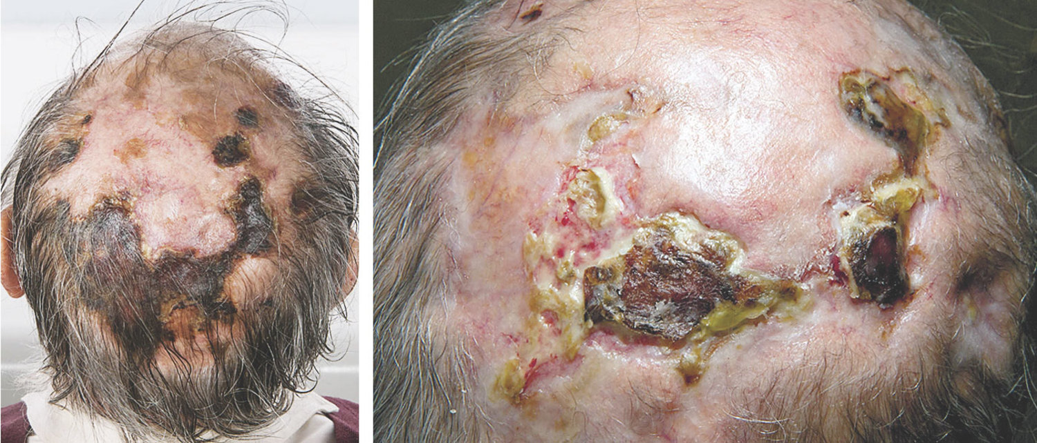 Giant-cell arteritis