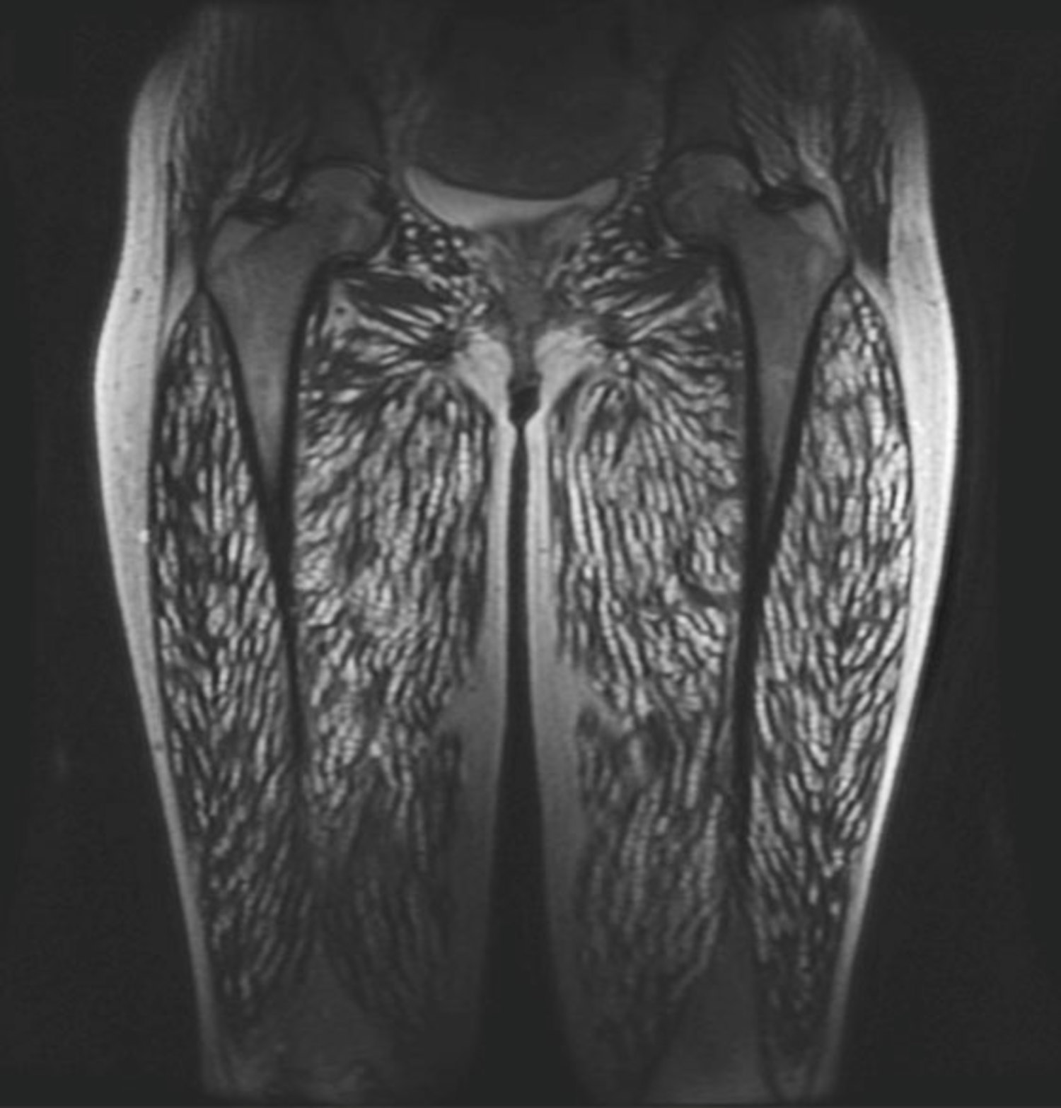 Cysticercosis