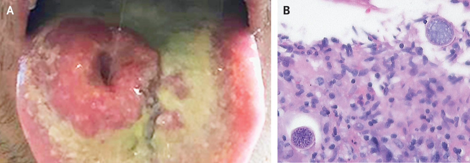 Disseminated coccidioidomycosis