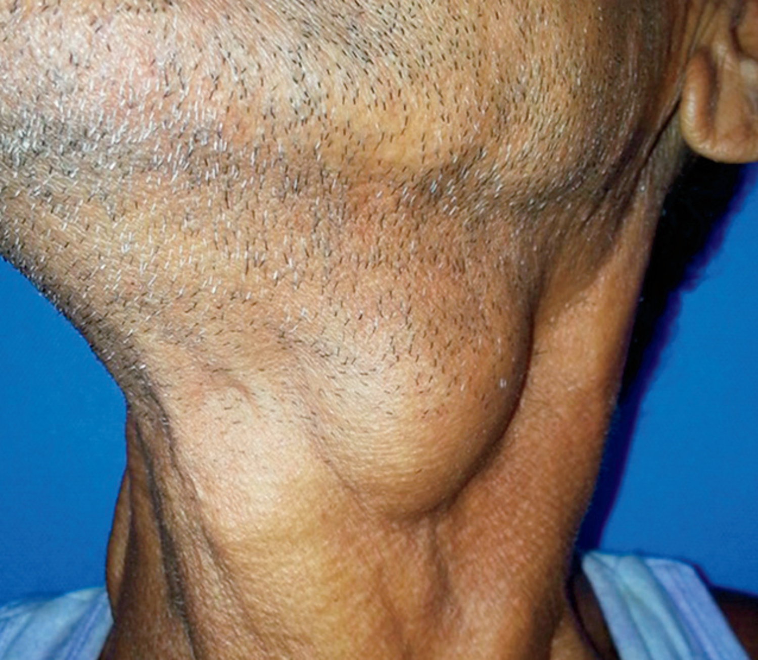 Laryngocele