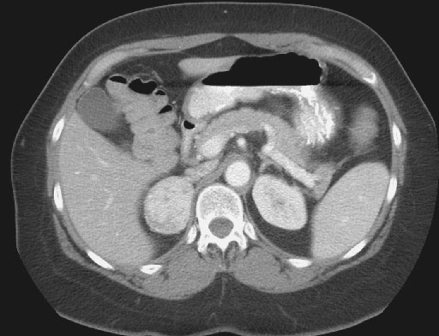 Pheochromocytoma