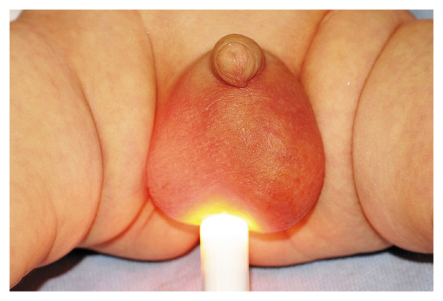 Left testicular torsion