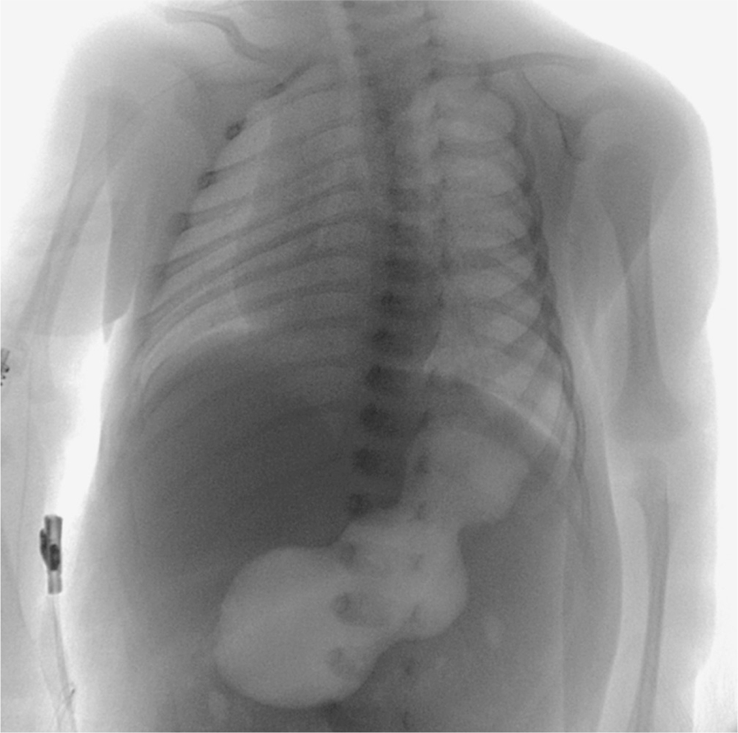 Pyloric stenosis
