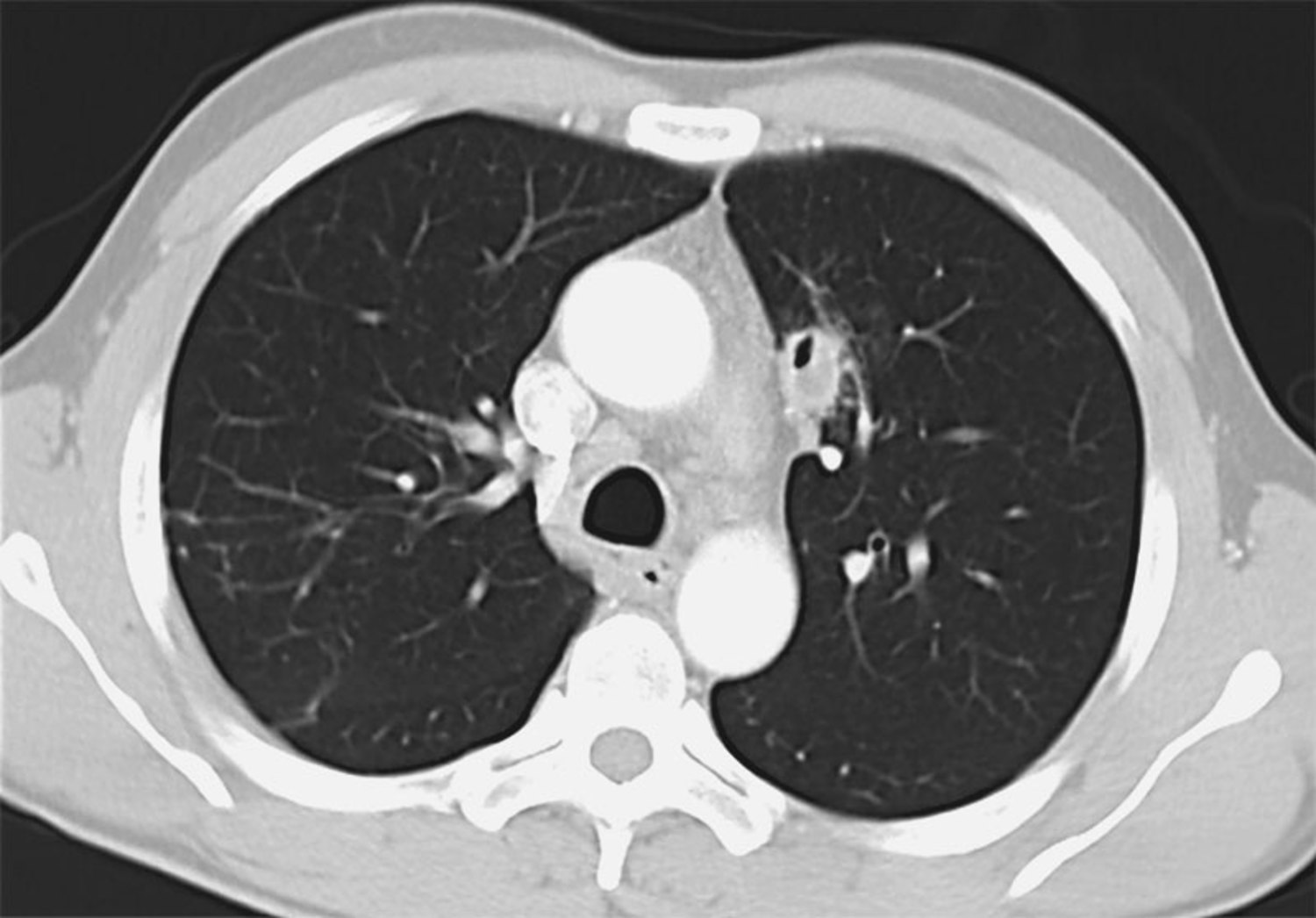 Pulmonary hypertension