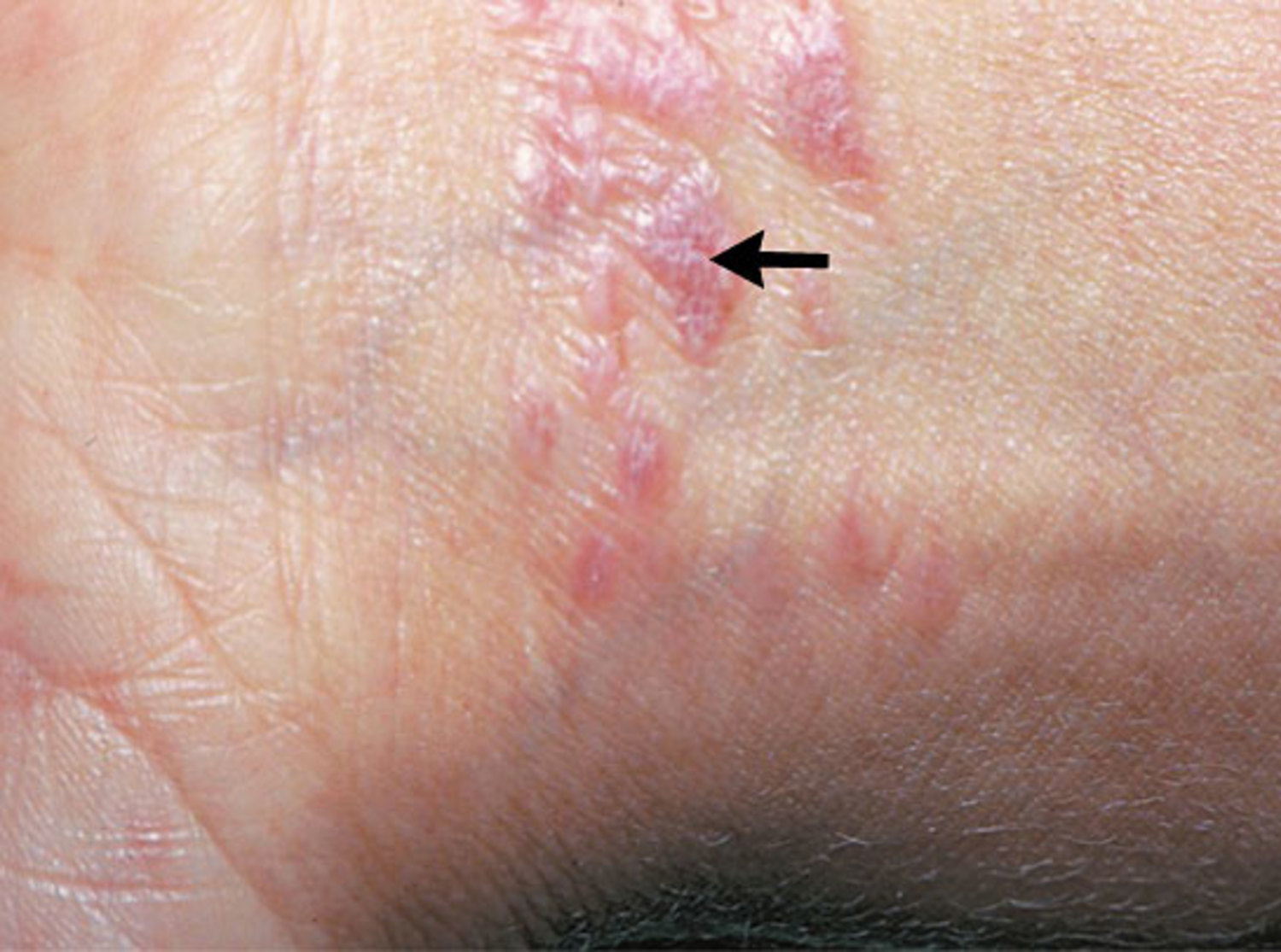 Lichen planus
