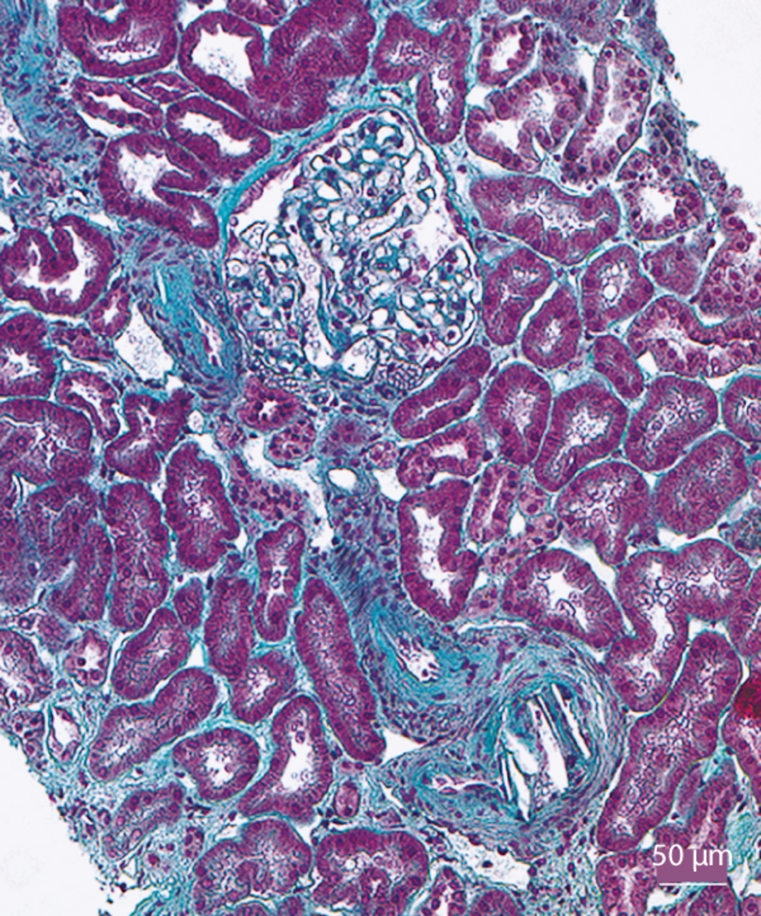 Cholesterol crystal embolization