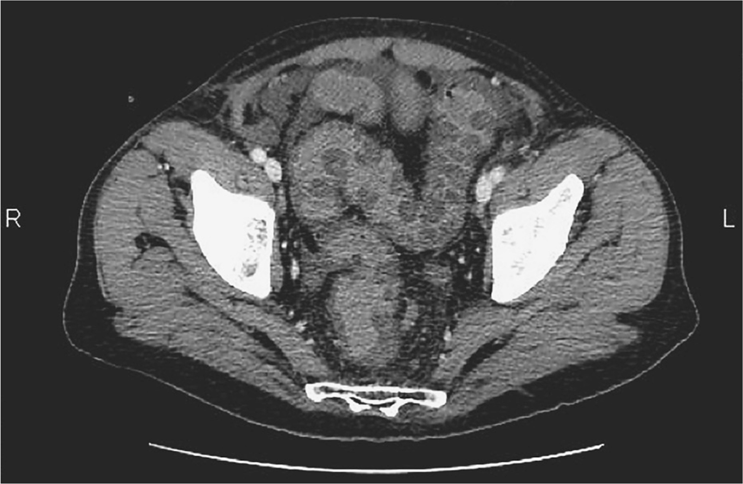Ischemic colitis