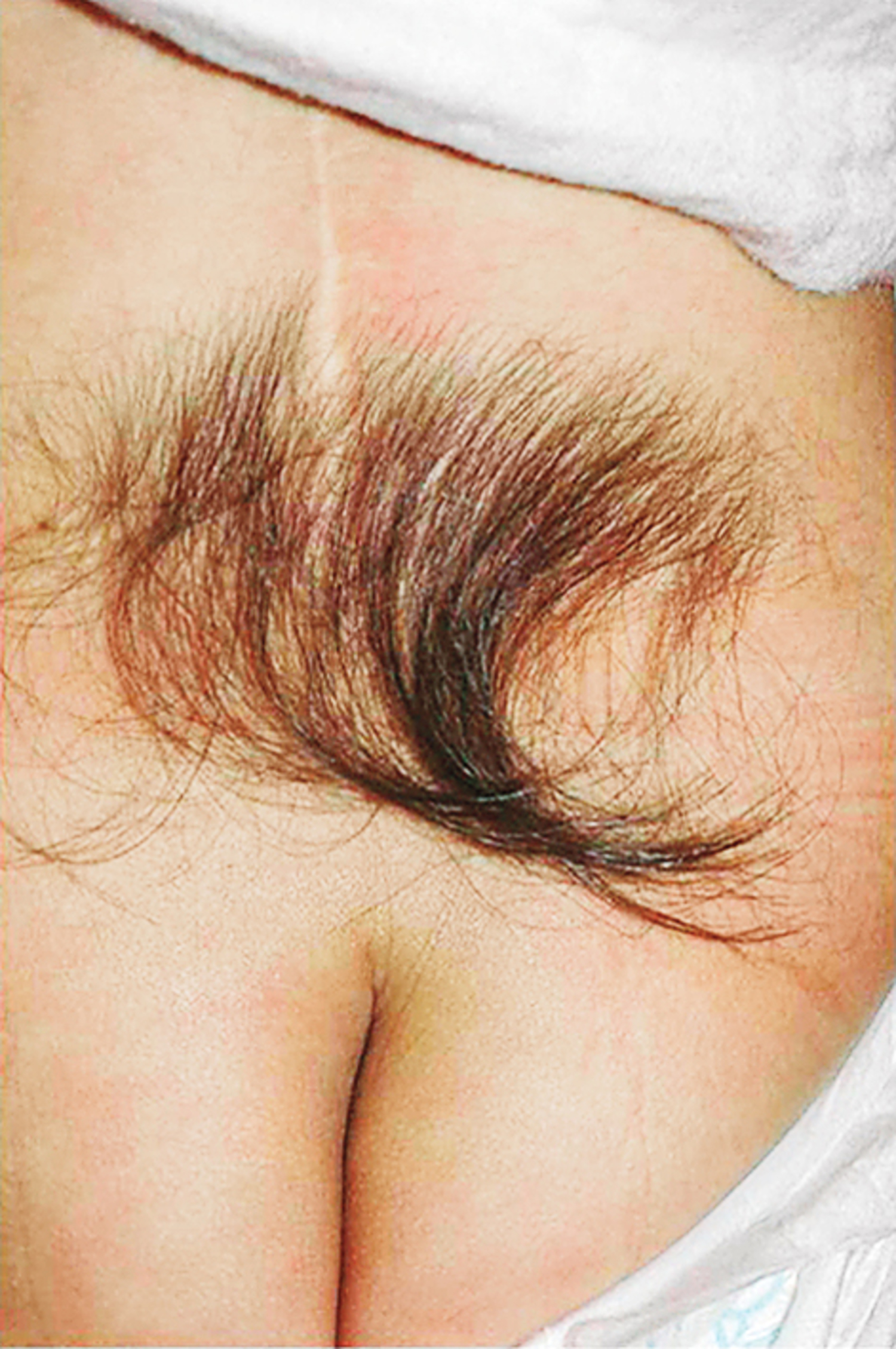 Spinal dysraphism