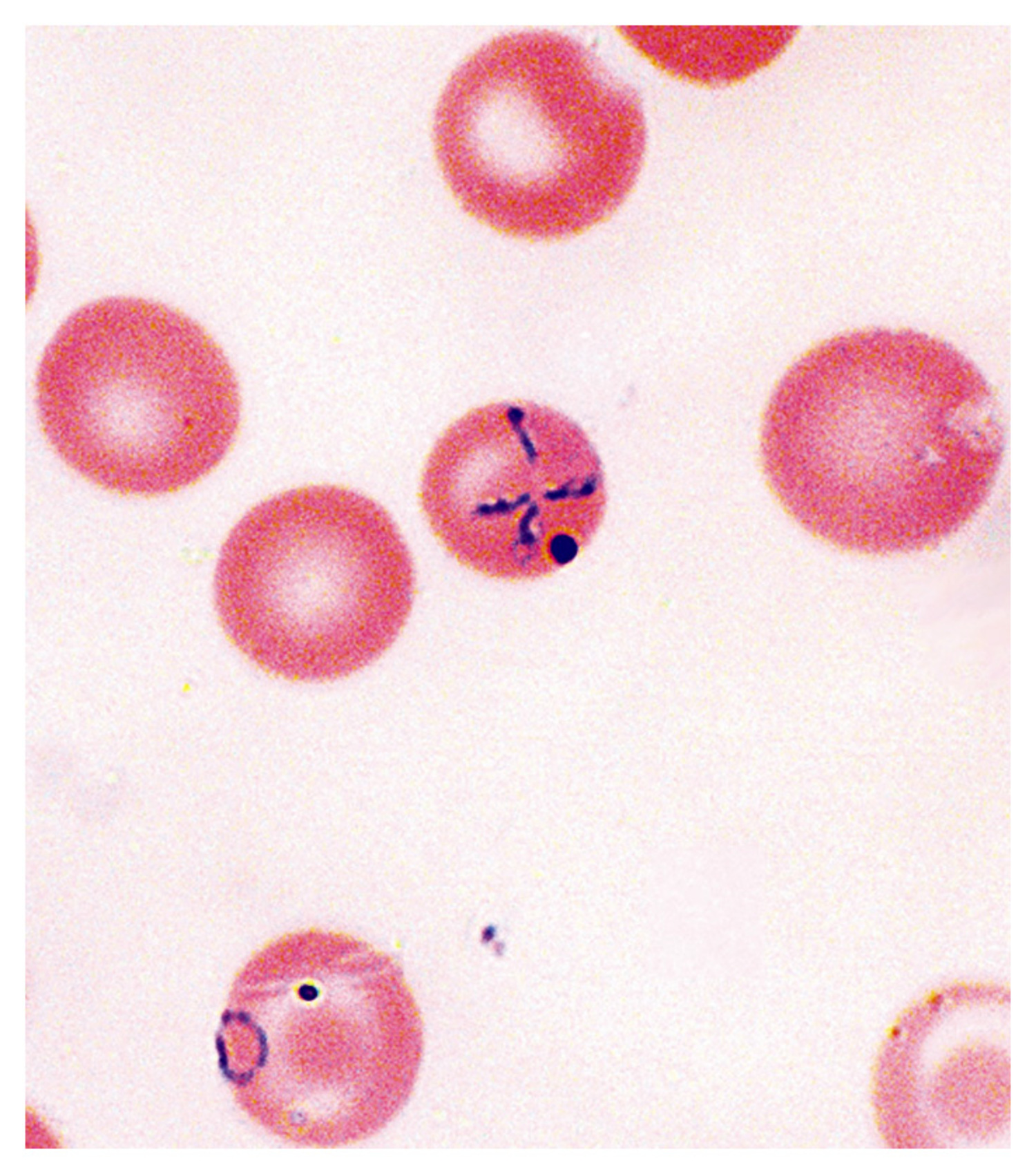 Babesiosis