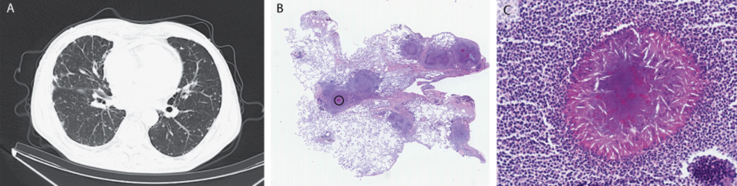 Actinomycosis
