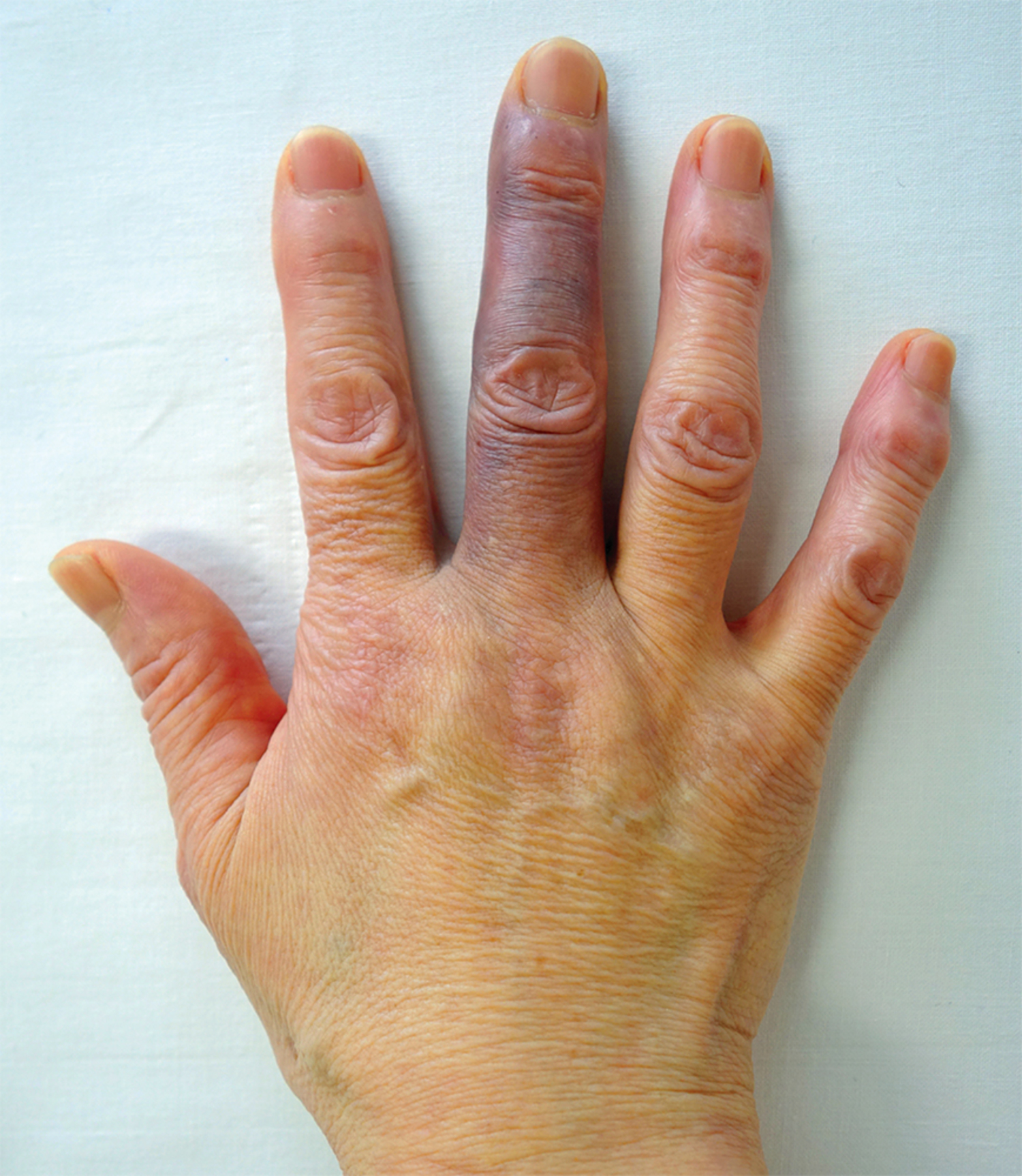Achenbach's syndrome