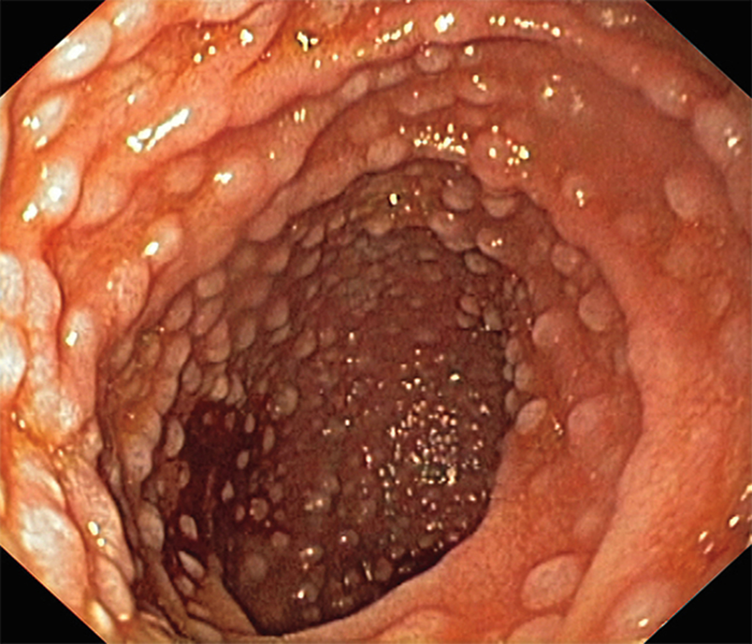 Nodular lymphoid hyperplasia