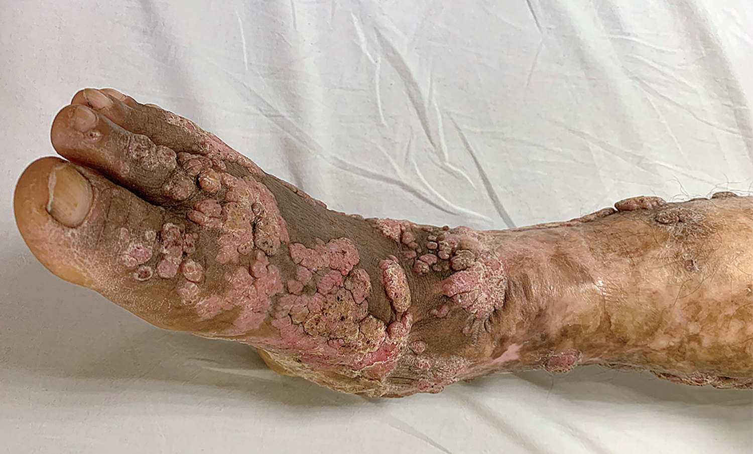 Chromoblastomycosis