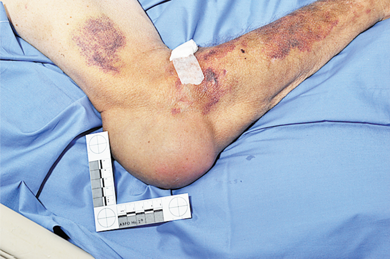 Gout nodulosis