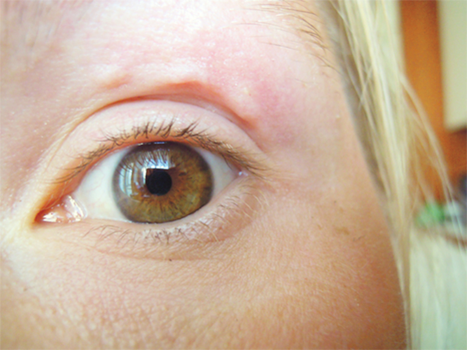 Dirofilaria repens infection