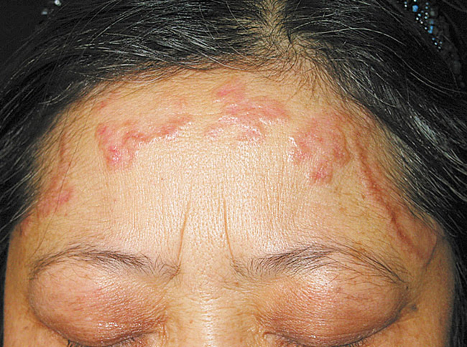 Actinic granuloma