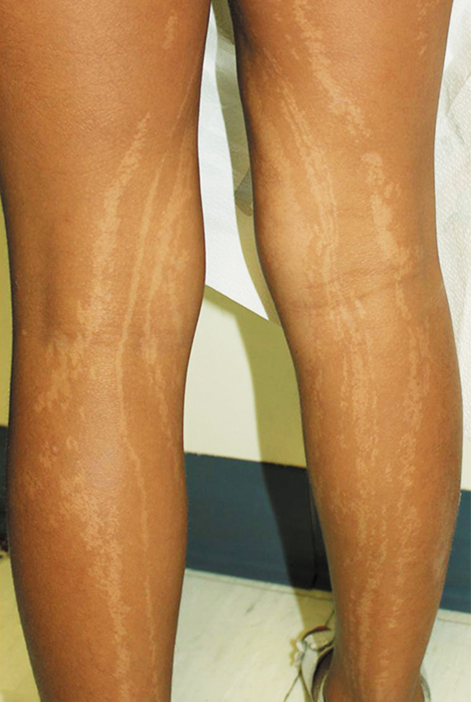 Pigmentary mosaicism