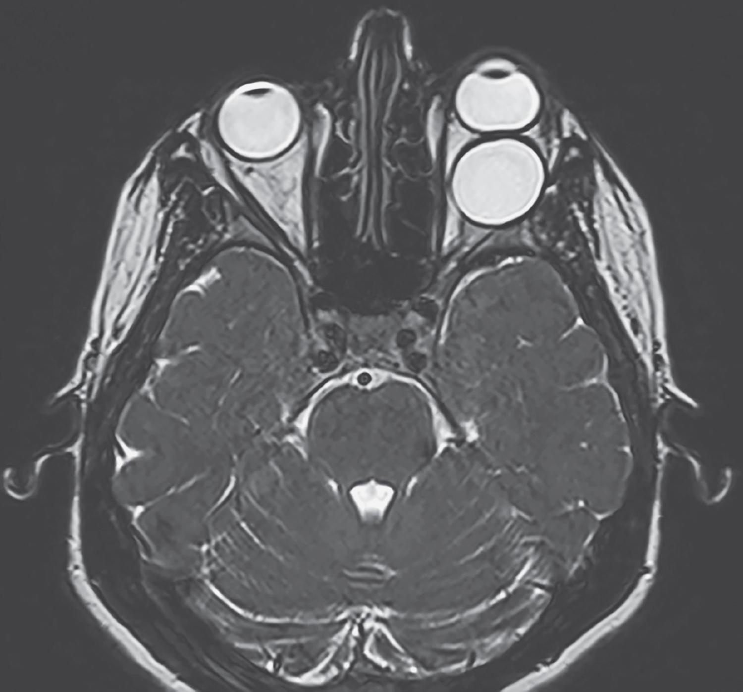 Hydatid cyst