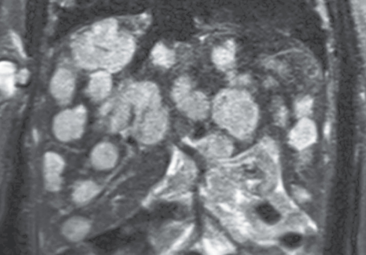 Infantile hepatic hemangiomas