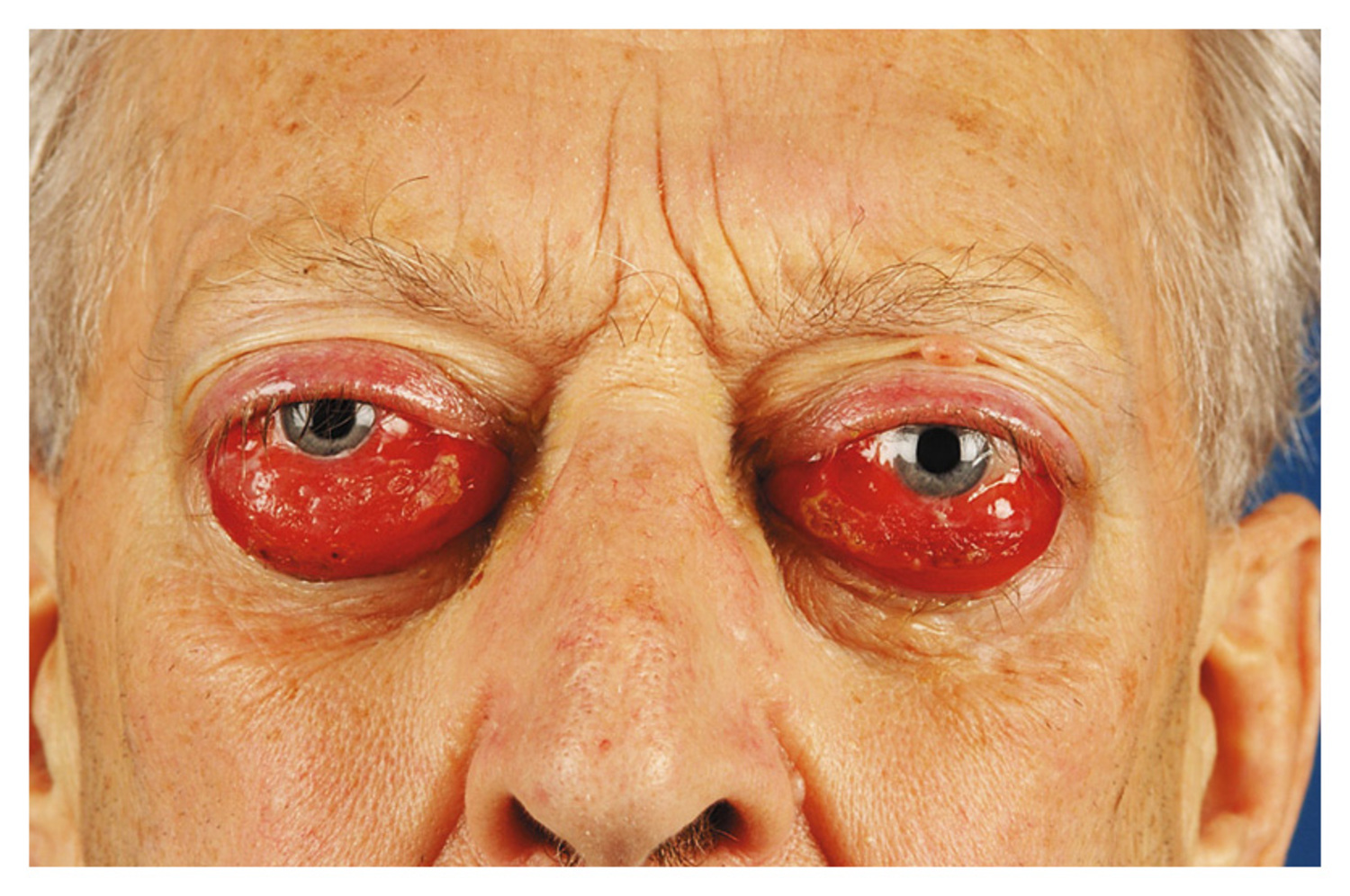 Lymphoma
