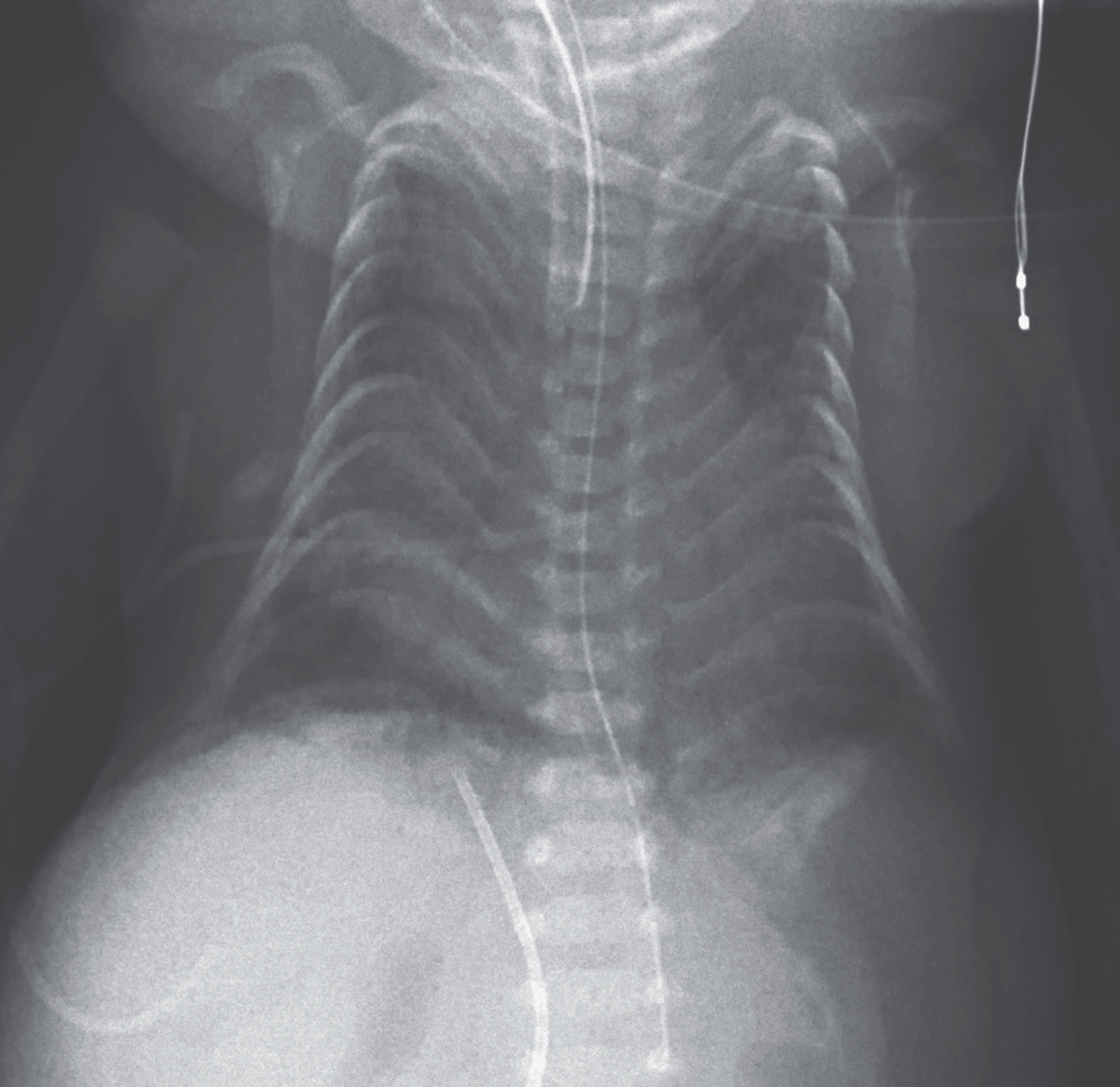 Paternal uniparental disomy 14 (UDP 14 pat) thoracic dysplasia