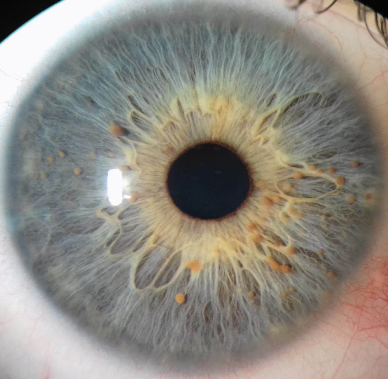 Lisch nodules