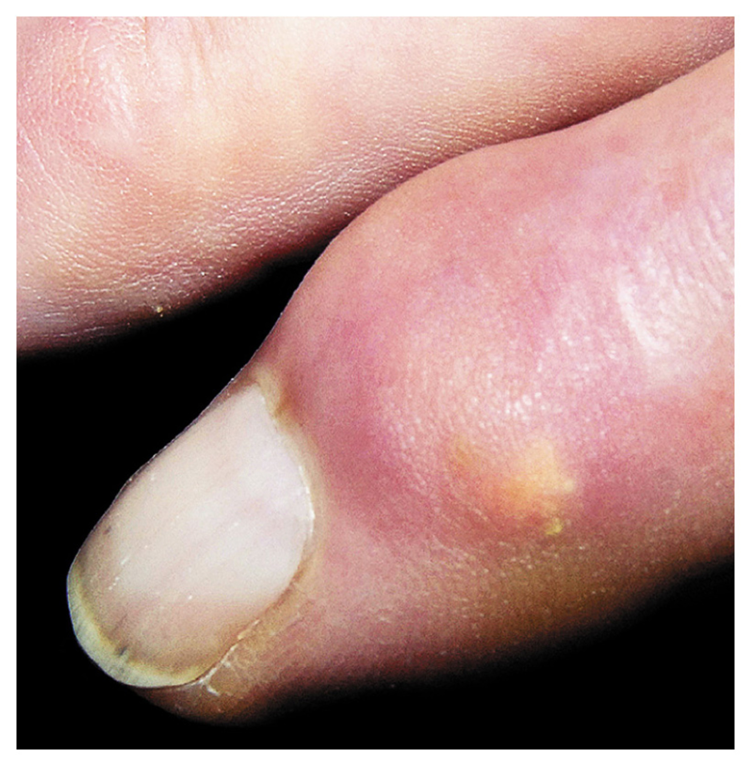 Gout