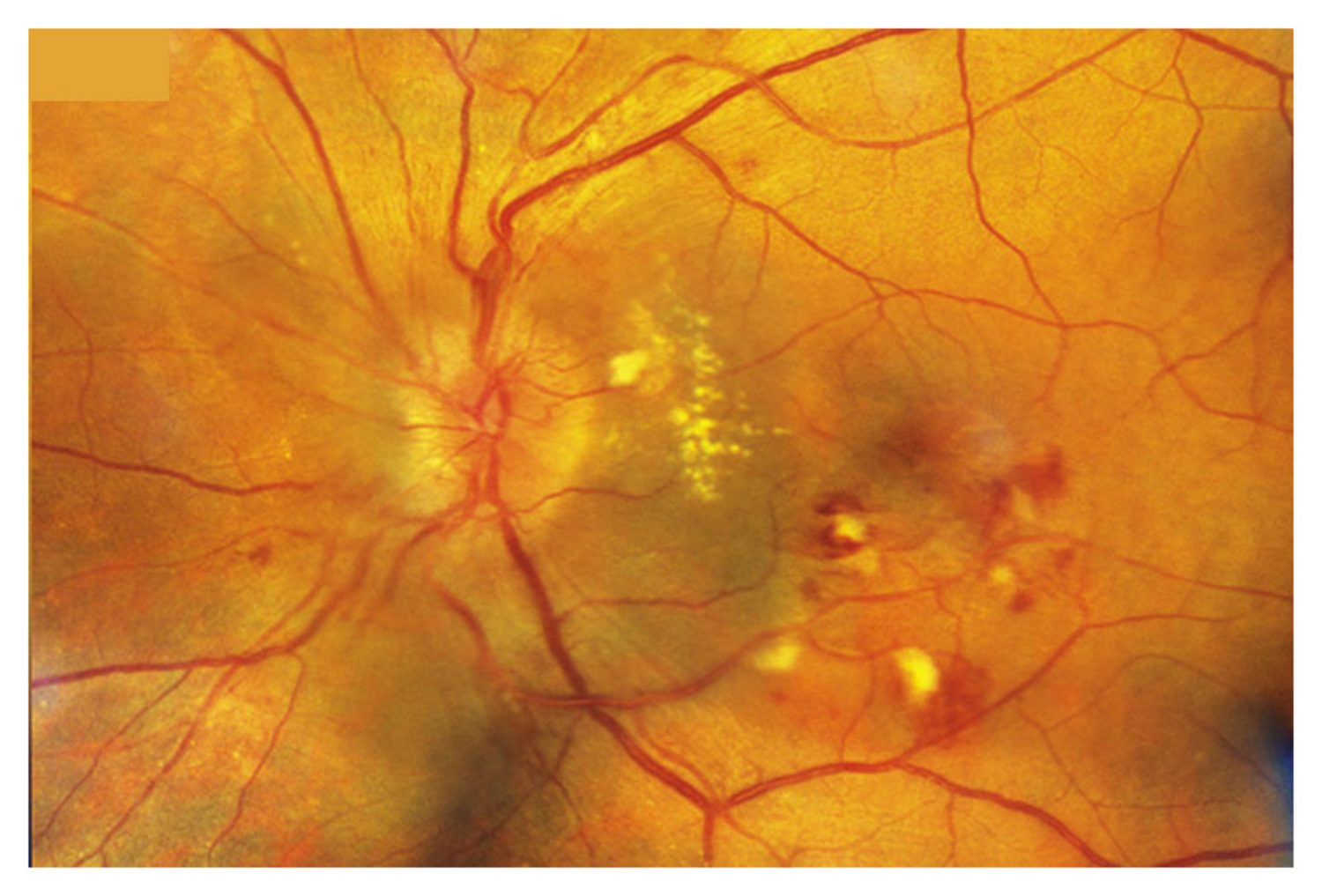 Malignant hypertension