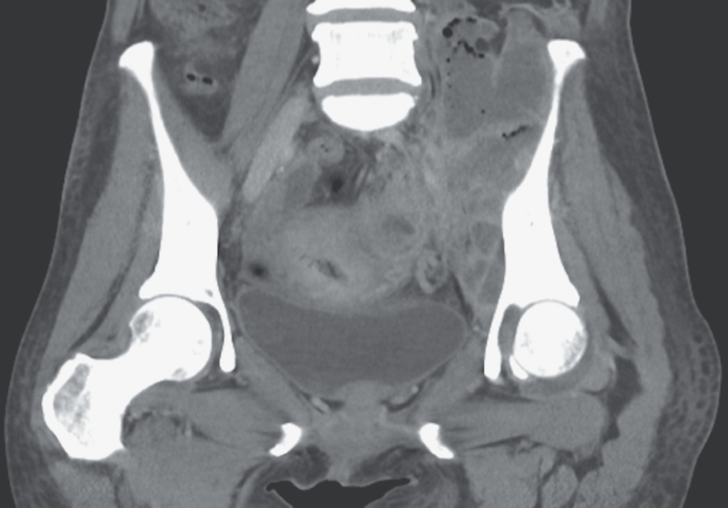 Actinomycosis