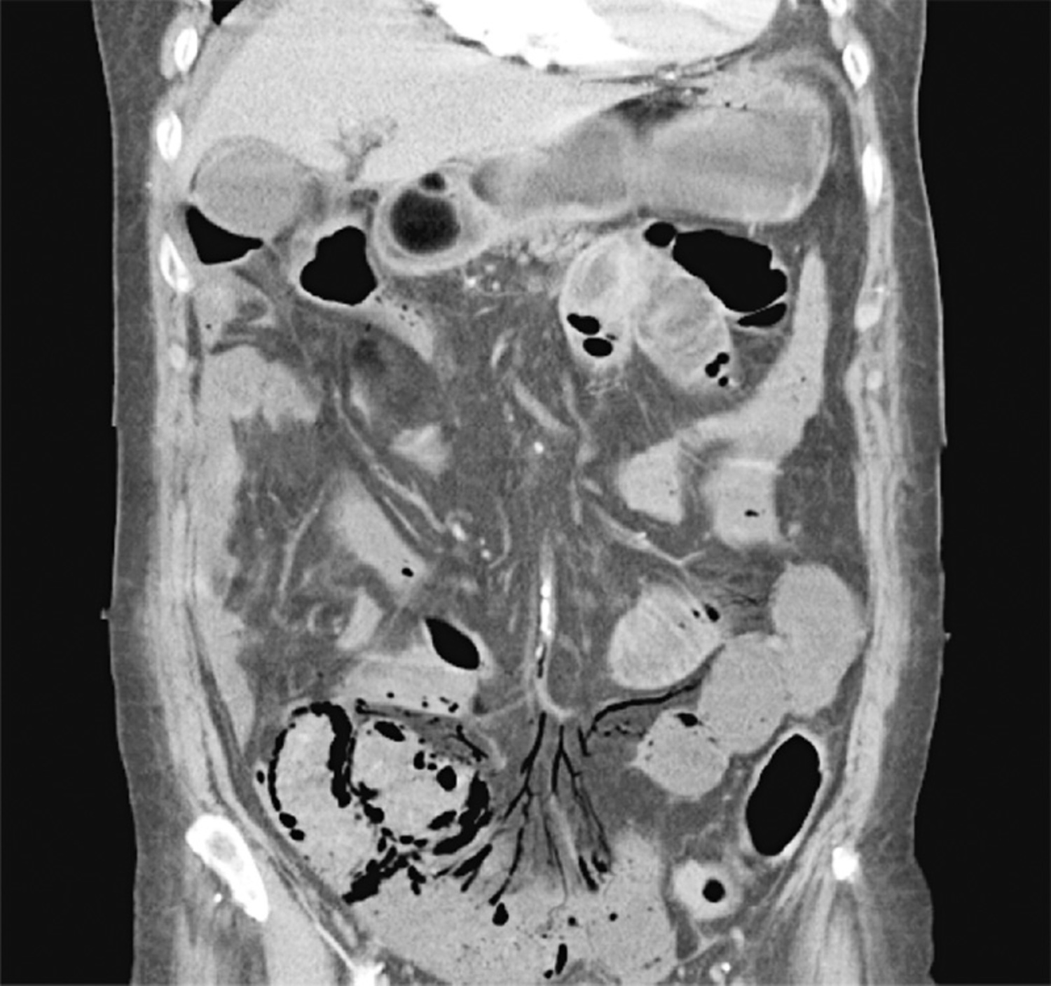 Mesenteric ischemia