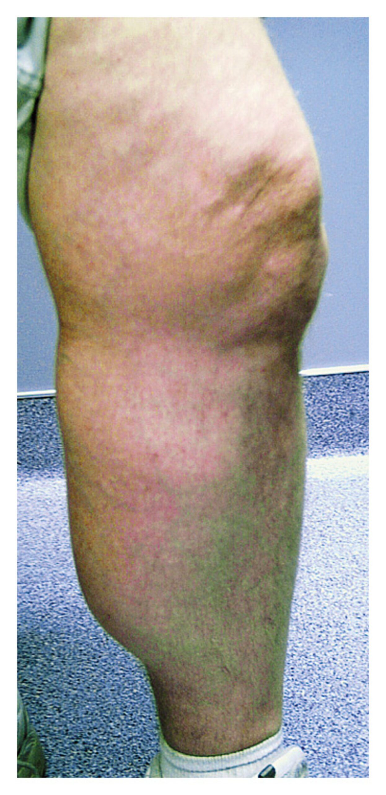 Baker's cyst