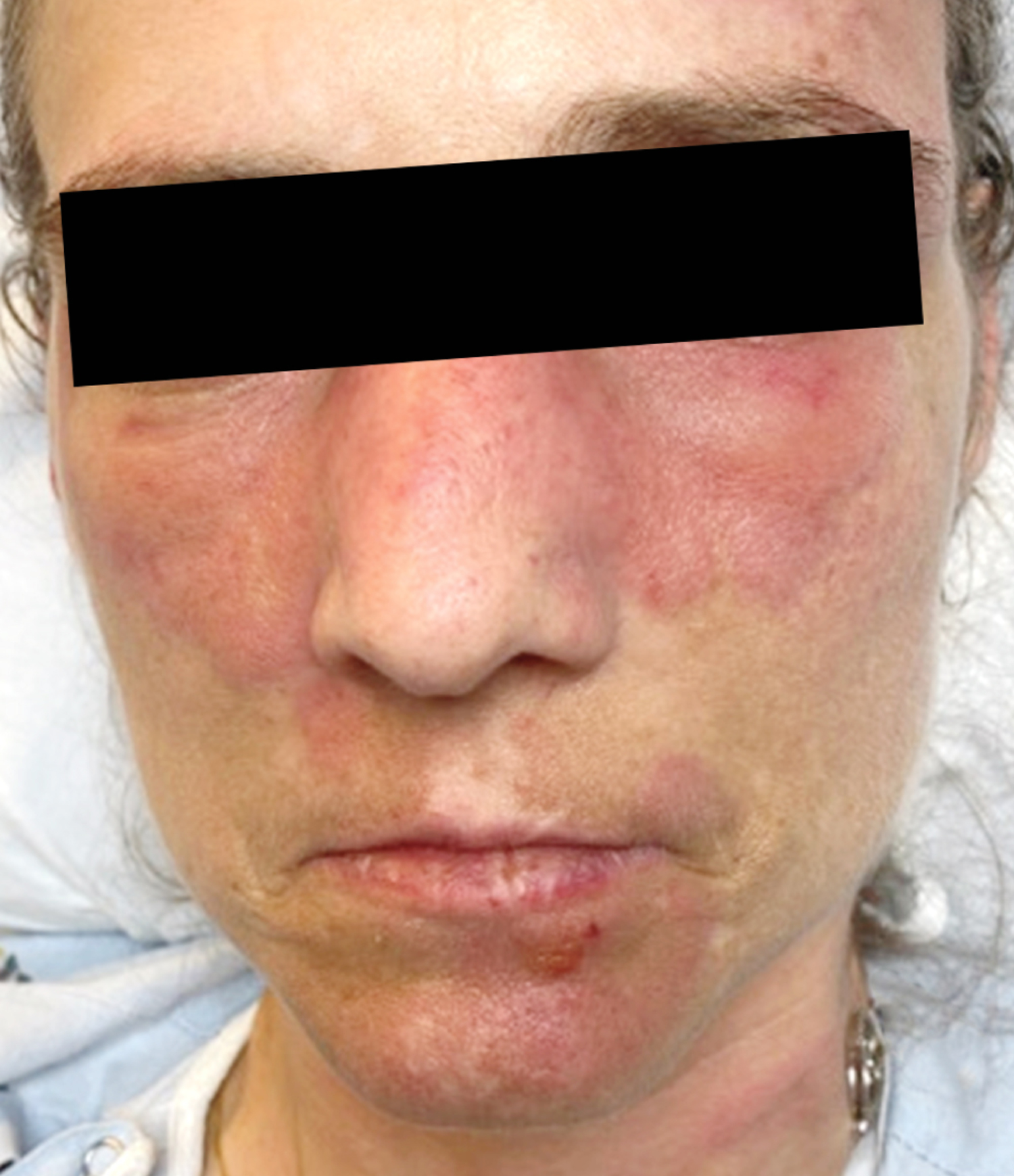 Neutrophilic eccrine hidradenitis