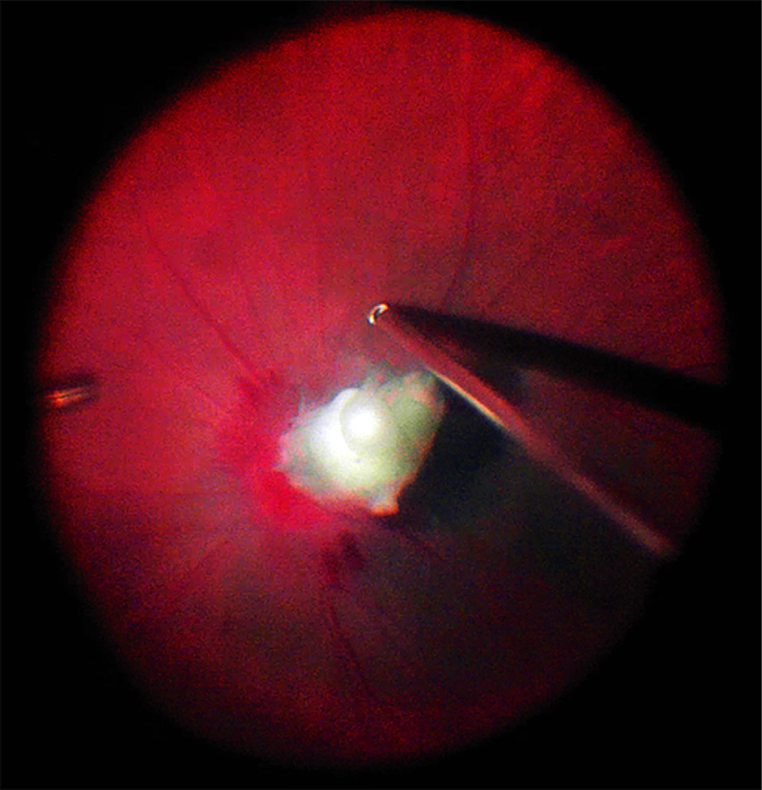 Fungal endophthalmitis