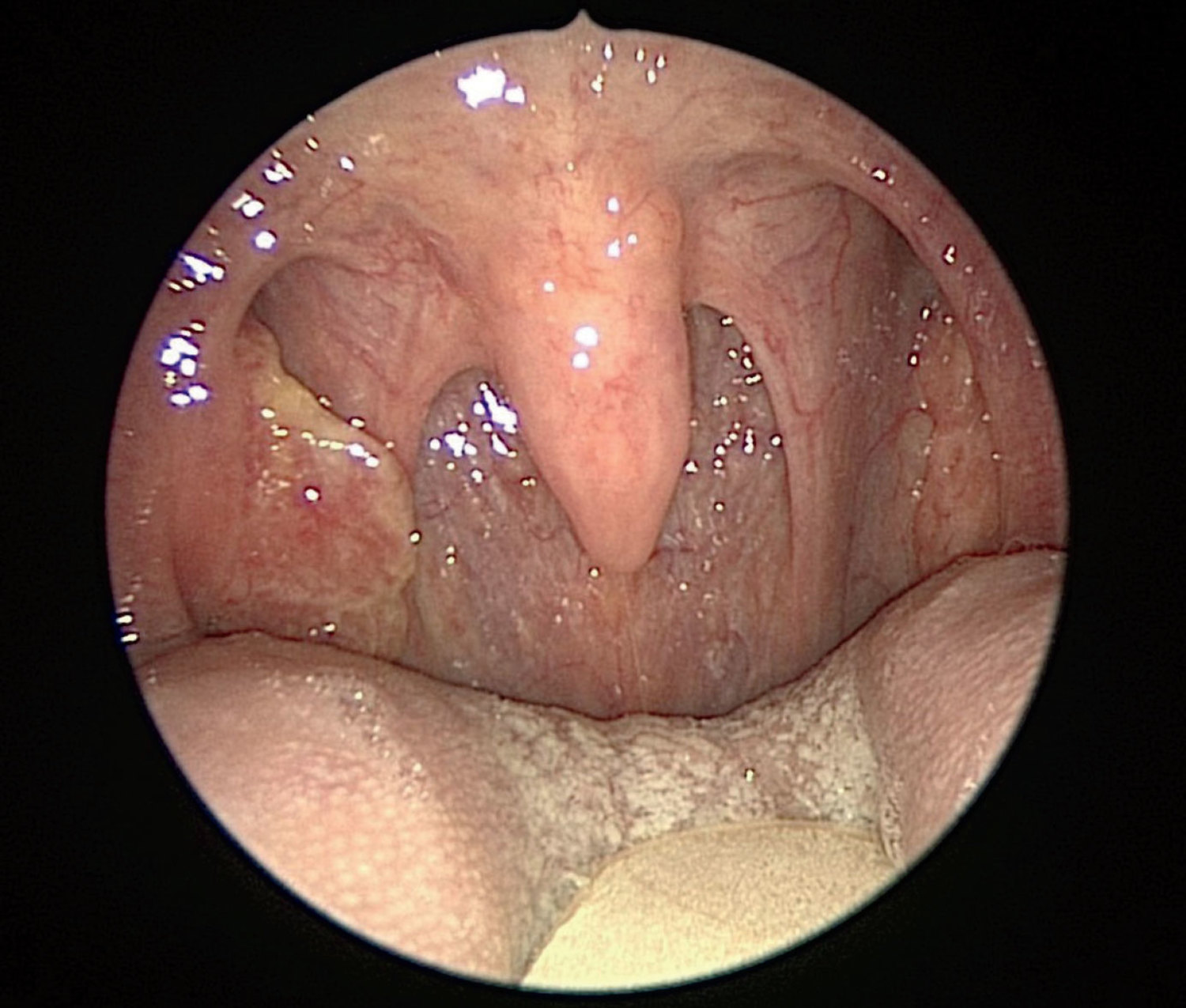 Tonsillar cancer
