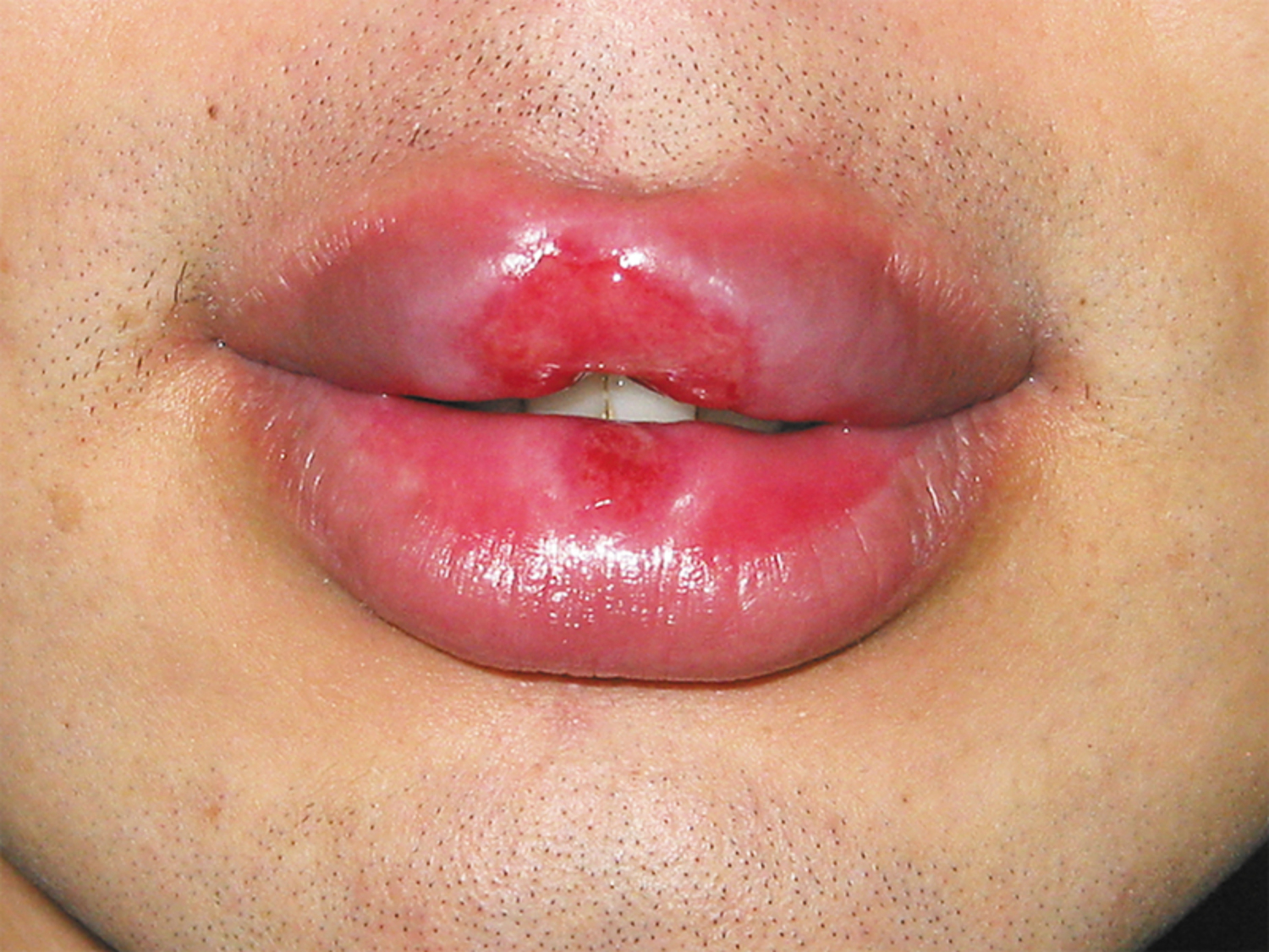 Syphilis