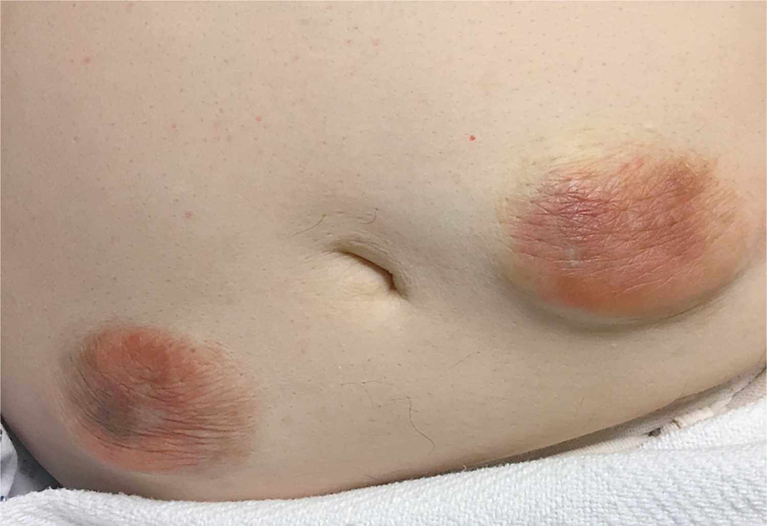 Insulin-induced lipohypertrophy