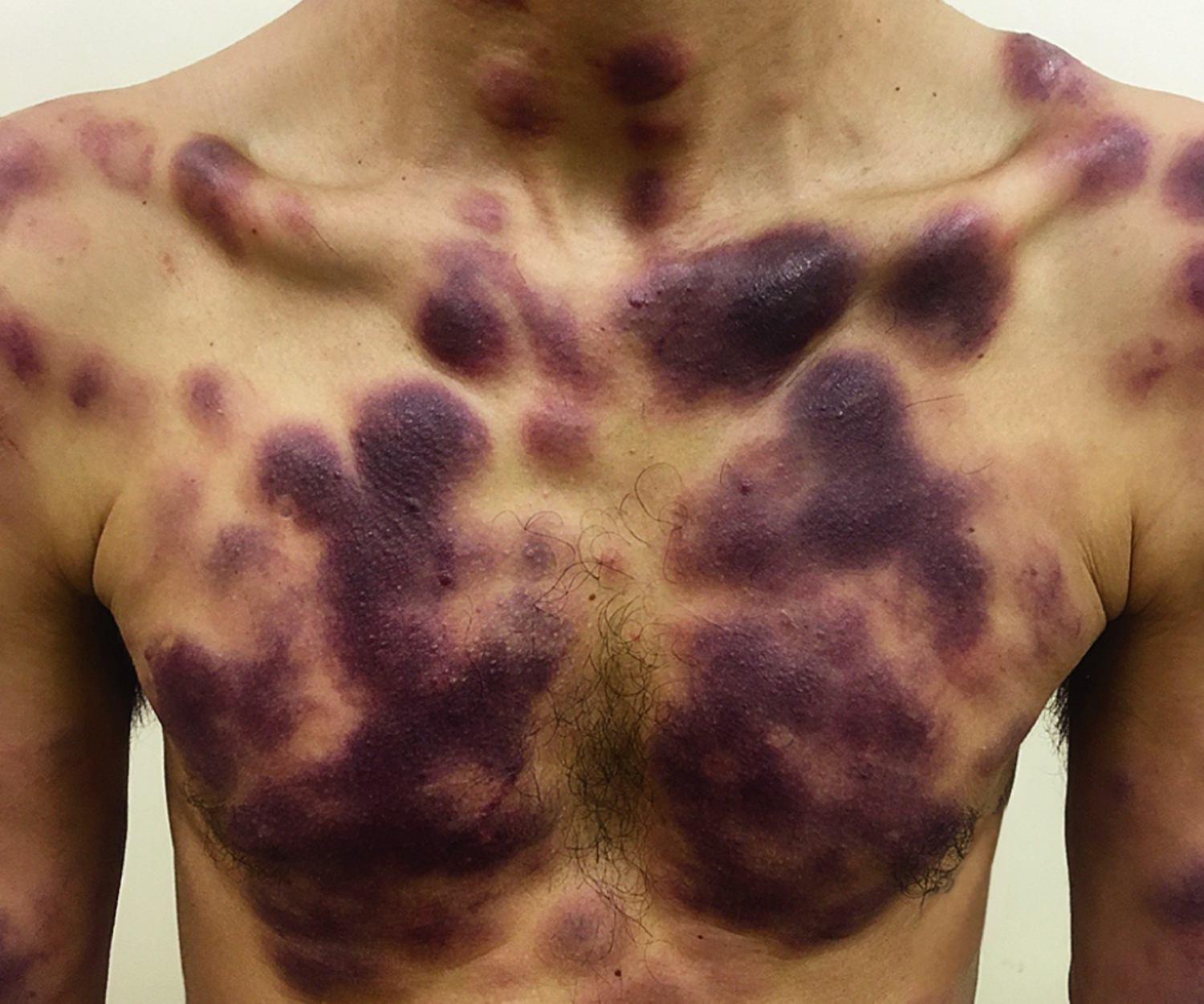 Blastic plasmacytoid dendritic-cell neoplasm