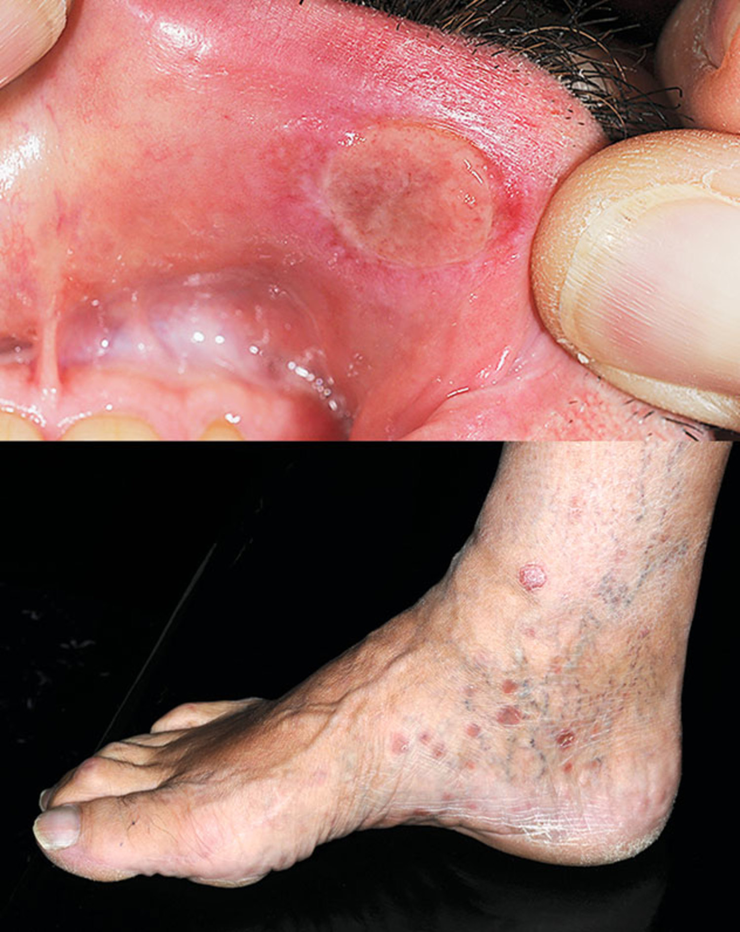 Treponema pallidum infection