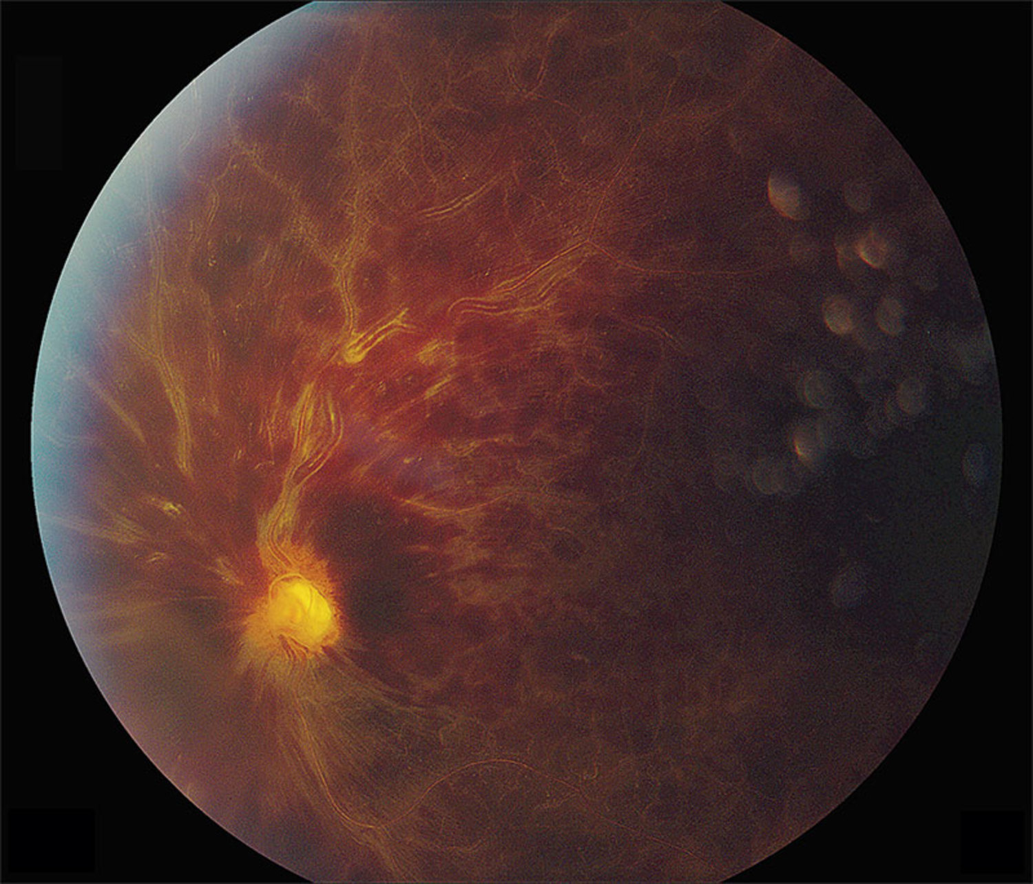 Narrow angle glaucoma